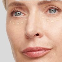 Under-eye filler with hyaluronic acid